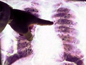 04 Πνεύμονας με κακοήθεις όγκους από αμίαντο