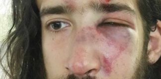 Σοκάρει η φωτό του στελέχους του ΣΥΡΙΖΑ που χτύπησαν άγρια φασίστες με κλωτσιές στο κεφάλι