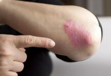 Παραμένει ο συναγερμός για κρούσμα ψώρας