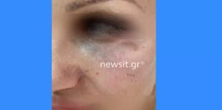 Τα χτυπήματα στο πρόσωπο της πρώην συντρόφου του Θέμη Αδαμαντίδη (βίντεο)
