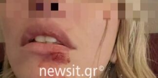 Φωτογραφίες ντοκουμέντο από τον ξυλοδαρμό που καταγγέλλει μοντέλο από τον πρώην σύντροφό της