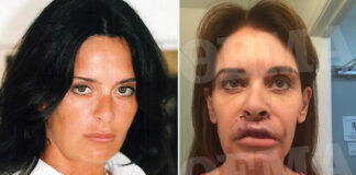 Πώς μια σαλάτα της προκάλεσε εχινόκοκκο και την έστειλε δύο φορές στο χειρουργείο
