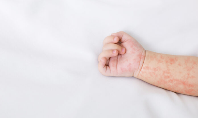 Hand,Of,Newborn,Baby,With,Measles,Rash,On,White,Sheet,