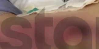 Έκανε επέμβαση ρουτίνας και βγήκε με εγκαύματα γ’ βαθμού – «Είχα γαντζωθεί στο κρεβάτι, έβραζαν τα πόδια μου»
