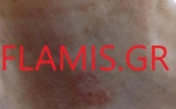 Λαγοκέφαλος δάγκωσε γυναίκα κοντά στην καρωτίδα
